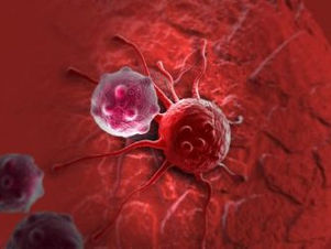 Vaginal Cancer Symptoms and Treatment - Oren Zarif - Vaginal Cancer