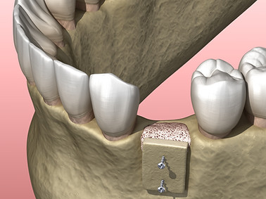 knochenblock knochenblockaufbau implantat zahnarzt dr. beck pfaffenhofen an der ilm zahnmedizin am loewenbrunnen