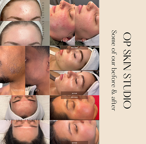Looking for 5 clients that want clear skin virtually (1).png