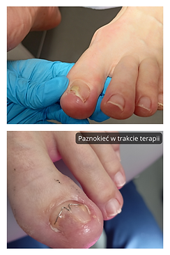 wrastający z wysiękiem, terapia klamrą ortonysyjną po jednym spotkaniu.png