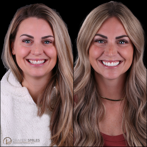 Smile Makeover by Dr. Fernando Pessoa, Draper Smiles, Utah - composite bonding