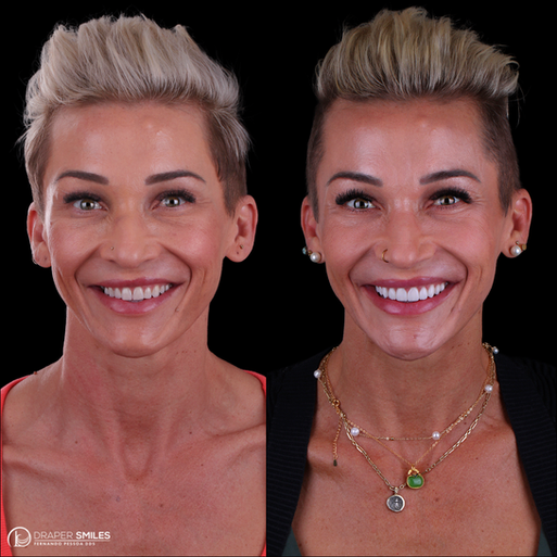 Smile Makeover by Dr. Fernando Pessoa, Draper Smiles, Utah - Composite Bonding and Porcelain Veneers