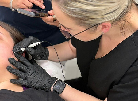 Jodie of JEMS treating an Age Spot blemish on a client using Advanced Electrolysis