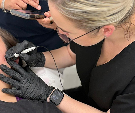 Jodie of JEMS treating an Age Spot blemish on a client using Advanced Electrolysis