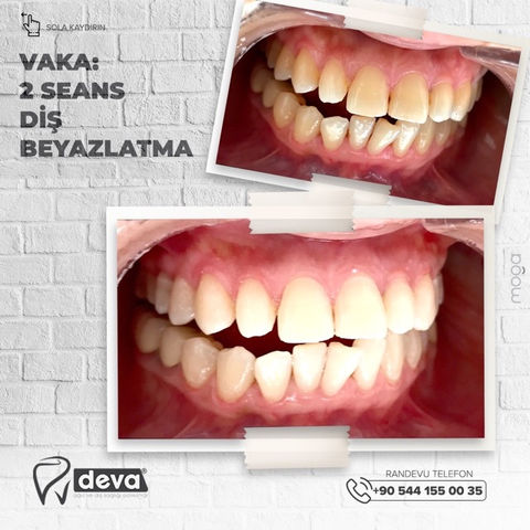 Teeth Whitening.jpeg