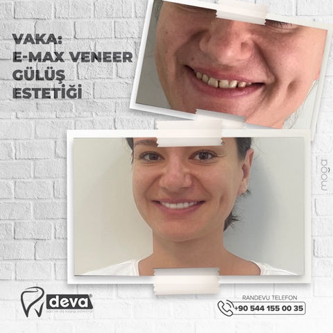 E-Max Veneer - Beautiful Smile.jpeg