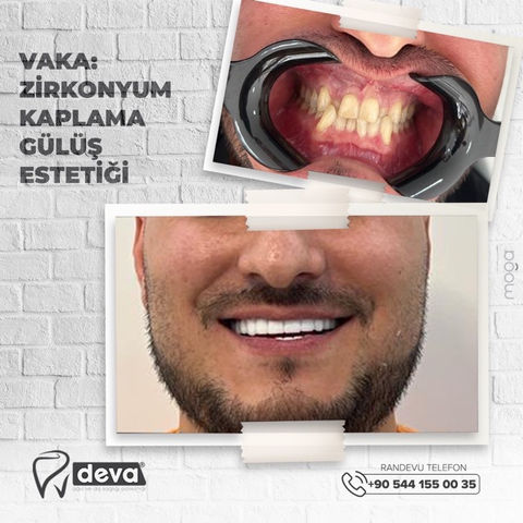 Zirconium Crown, Beautiful Smile.jpeg
