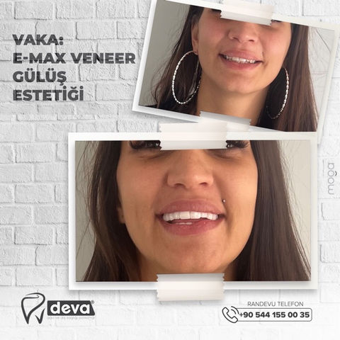 E-max Veneer and Beautiful Smile.jpeg