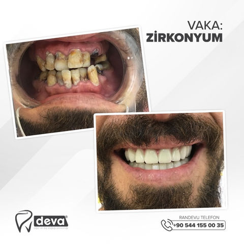 Zirconium Crown.jpeg