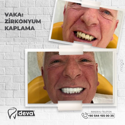Zirconium Veneer.jpeg