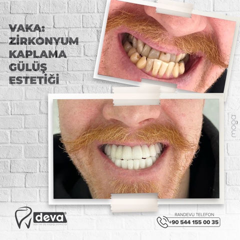 Zirconium Crown and Beautiful Smile.jpeg