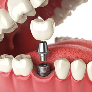 Immediate Loading Dental Implants Gaining Widespread Popularity