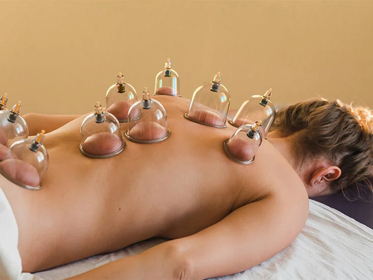 Female_Cupping_Therapy_732x549-thumbnail-732x549.webp