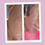 Thumbnail: ACNE BUNDLE