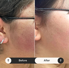 לפני אחרי פנים פוסט.png