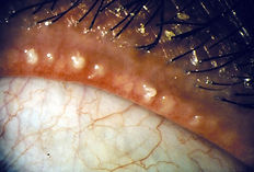 Posterior Blepharitis