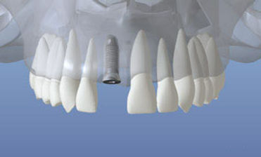 dentalimplant_05.jpg