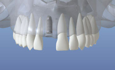 dentalimplant_04.jpg