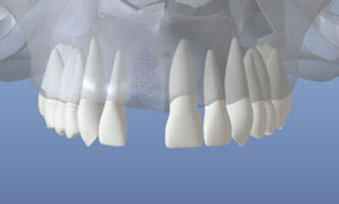 dentalimplant_03.jpg