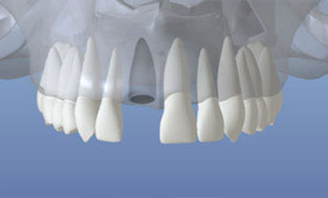 dentalimplant_02.jpg