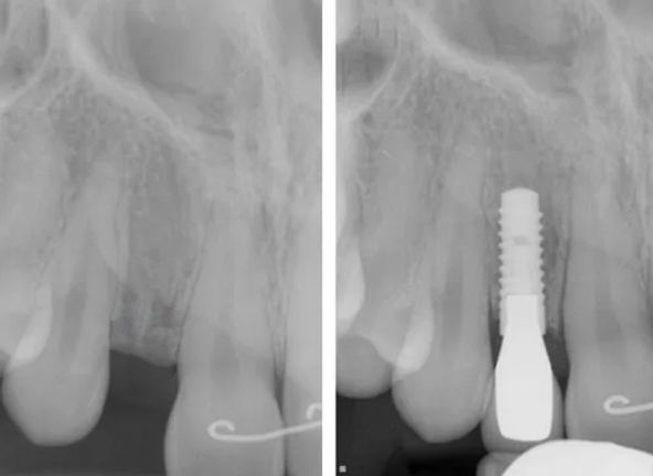 singple implant surgical.jpg.jpg