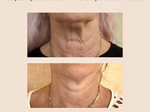 ENDOLIFT 
