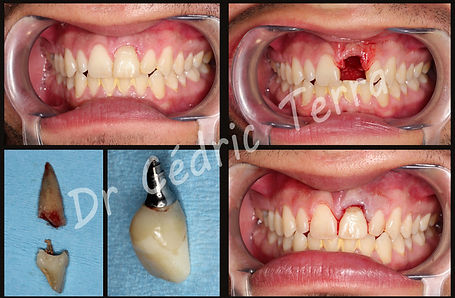 implant incisive extraction-implantation-immédiate