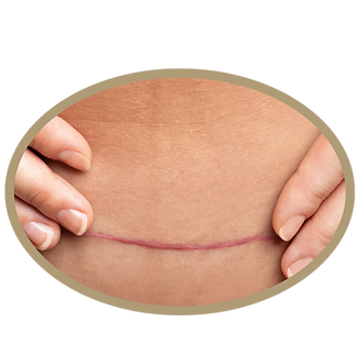 c section (1)_edited.png