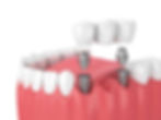 Bridge de 3 dents fixé sur 2 implants