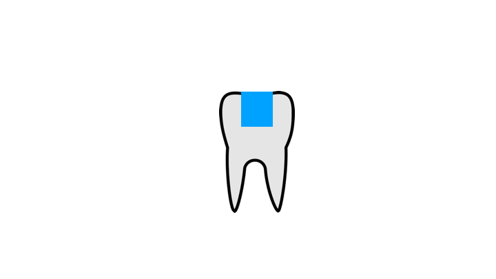 dilatation amalgame plombage