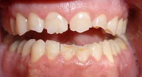 Dental erosion: causes and solutions
