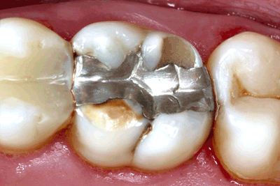 Remplacement plombage en couronne