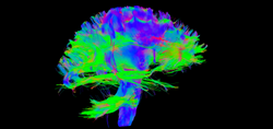 DTI brain I traced