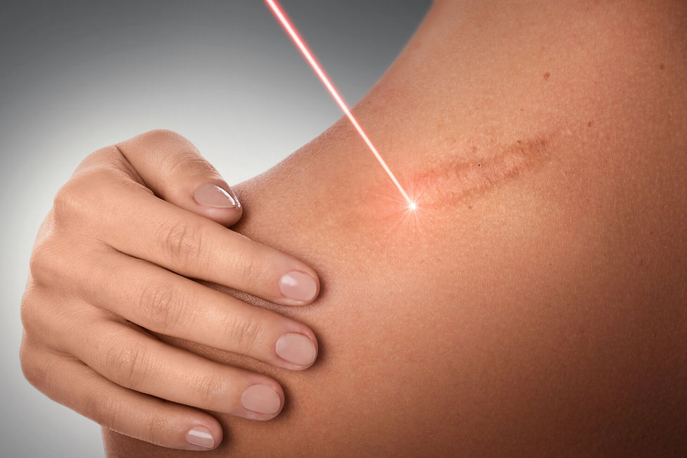 laser-scar-removal-composite-red-beam-shoulder-1480.jpeg