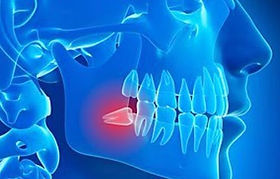 extraction de dents de sagesse