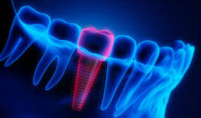 pose implant dentaire/ chirurgie implantaire