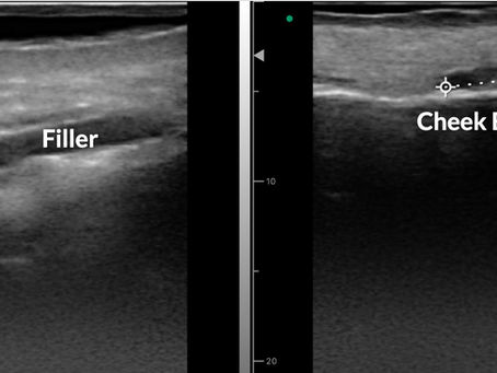 When Hyalase Doesn't Work - What Ultrasound Reveals