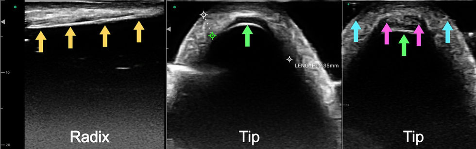 POCUS assessment revealed a black, uniform, hypoechoic structure slanting upwards (see trajectory of yellow arrows, rightmost is towards the forehead) at the radix, suggestive of the silicone implant tail (left). At the tip, transverse views suggest that the same hypoechoic structure has been placed or migrated slightly posterior (green arrow) (middle); a slightly different view shows that what looks like the ear cartilages (pink arrows) are sitting in front of the silicone implant (green arrow), leading to a blunted tip (blue arrows) (right).