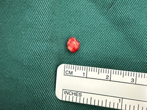 Wide Awake Hand Surgery - No Tourniquet, Home the Same Day