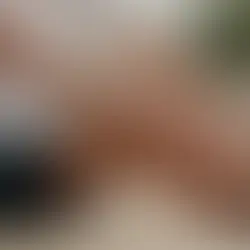 Exploring Ehlers Danlos Syndrome and Iliotibial Band Syndrome