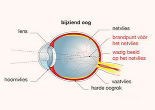 Myopie bijziendheid