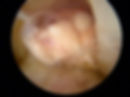 Arthroscopy of the knee ligament