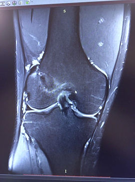 Операция на ПКС