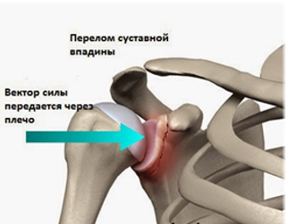 Перелом плечевого сустава. Операция на плечевом суставе.