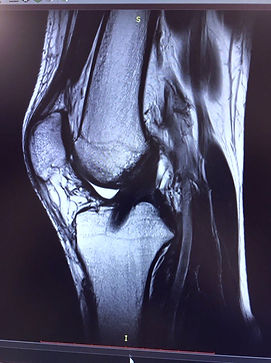 Замена крестообразной связки
