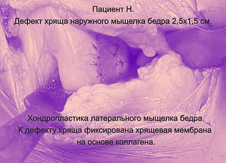 Повреждение хряща коленного сустава. Операция на хряще коленного сустава. Хондропластика.