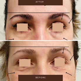 Before and after buccal massage results around eyes and forehead — Face Massage School USA lifting technique showing reduced swelling and fine lines
