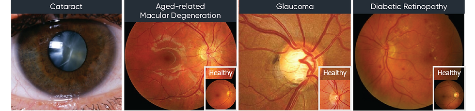 eye diseases.png