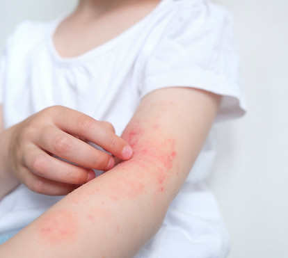 発疹ができた腕をかく子ども