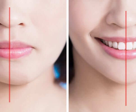 jaw-misalignment-treatment-orthodontist-1000x499.jpg